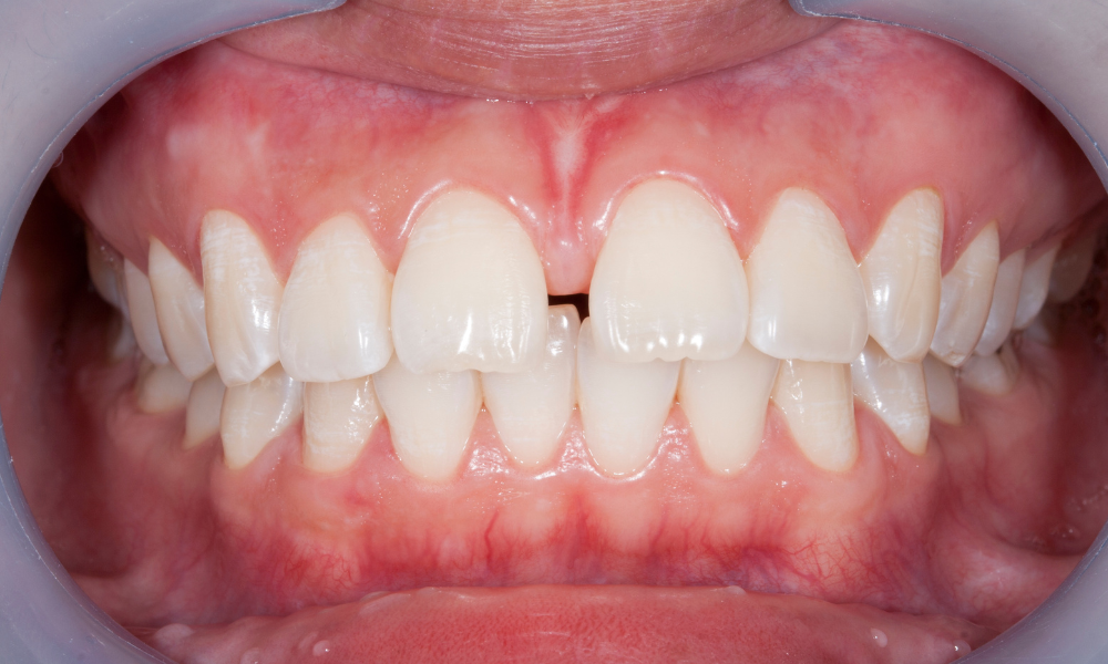 Diastema